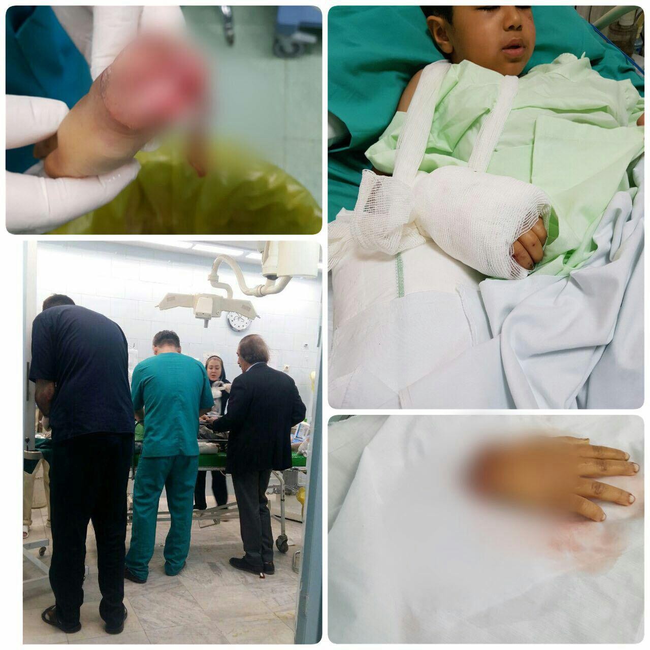 پیوند دست قطع‌شده کودک زلزله‌زده