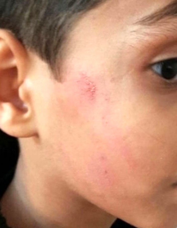 ردِ انگشتر مدیر روی صورت دانش‌آموز بعد از ۲۰ روز!