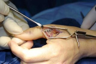 درمان مزمن رگ به رگ شدن انگشت شست