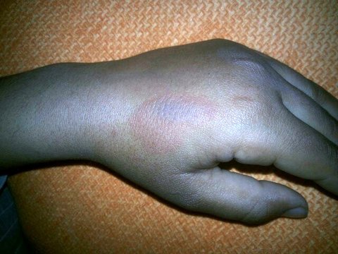 سوزندان دست دانش‌آموز نظرآبادی به وسیله قاشق داغ ! + عکس