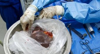 اهدای اعضاء کودک 6 ساله برخواری به 3 بیمار نیازمند