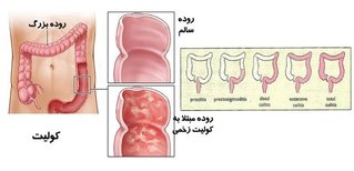 کولیت؛ لاعلاج یا صعب‌العلاج؟!