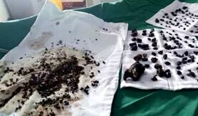 خارج کردن 200سنگ صفرا از بدن زن چینی