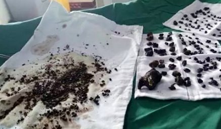 خارج کردن 200سنگ صفرا از بدن زن چینی