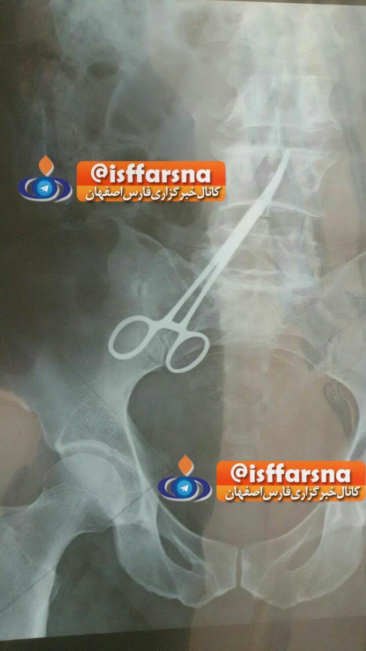 جا ماندن پنس در شکم بیمار زواره‌ای !