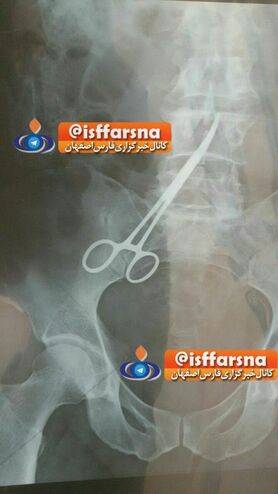 جا ماندن پنس در شکم بیمار زواره‌ای !
