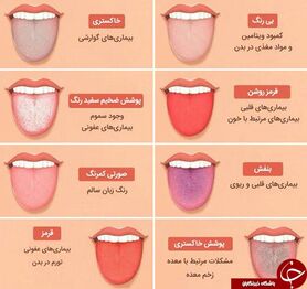 تشخیص بیماری با رنگ زبان
