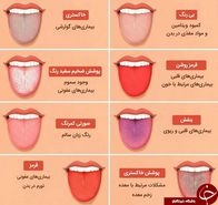 تشخیص بیماری با رنگ زبان