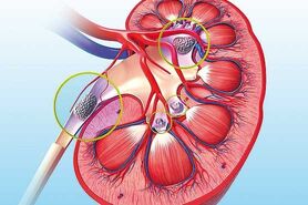 خوردن چای و شکلات زیاد از دلایل ایجاد سنگ کلیه در اصفهان است