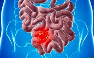 علائم سرطان روده را بشناسید
