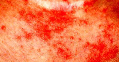 ۶ راهکار ساده برای درمان اگزمای پوستی