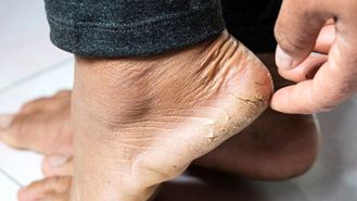 درمان ترک پاشنه پا به روشی ساده و سریع