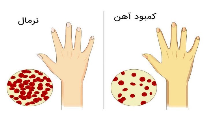 بارزترین نشانه‌های کمبود آهن و روش بالا بردن آهن خون