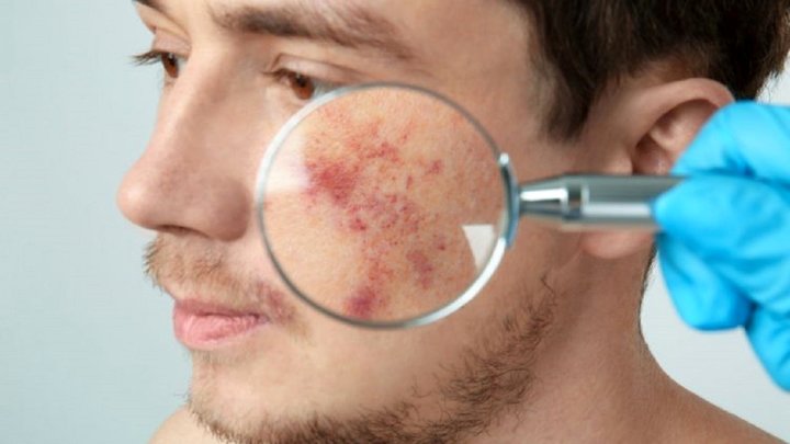 توصیه‌های مهم برای جلوگیری از آفتاب سوختگی