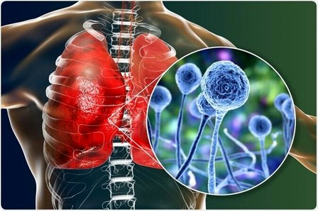 آیا تجویز اشتباه پزشکان موجب شیوع قارچ سیاه شده است؟