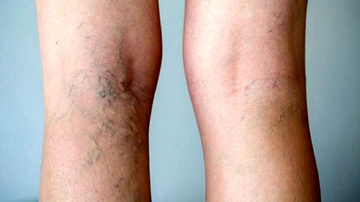 عادت‌های غلطی که نمی‌دانستید باعث واریس می‌شوند