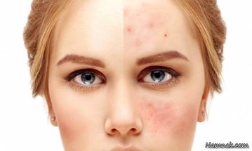 کدام قسمت از صورتتان جوش می زند؟ + علت و درمان