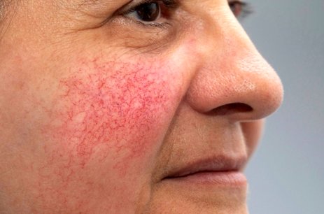 تغییرات پوستی که نشانه ای از بیماری کبد هستند