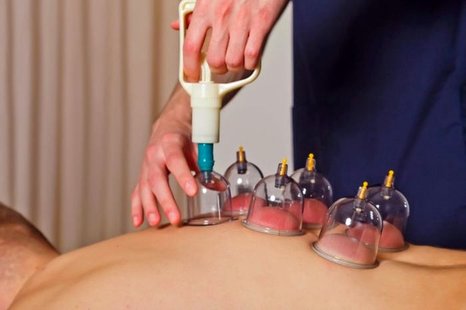 14 مزایای ناشناخته بادکش درمانی برای سلامتی