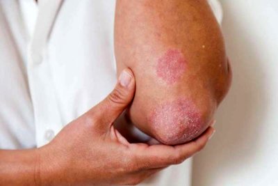 قارچ پوستی چیست ؟ چه علائمی دارد و چطور درمان می شود؟