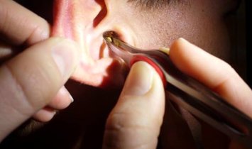 دلیل بوی بد جرم گوش و آنچه این چسبناک زرد به شما می گوید