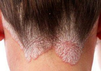 عامل بیماری پسوریازیس پروتئین‌ است