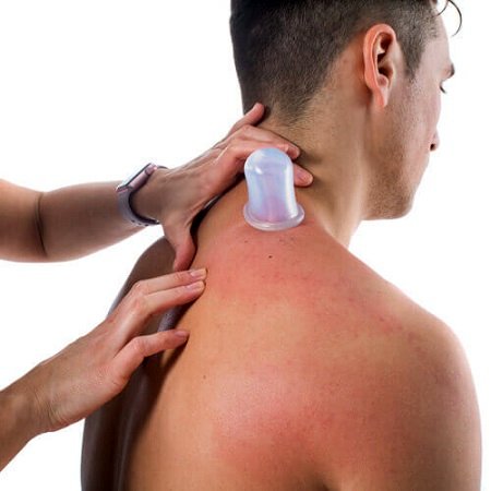 آیا بادکش درمانی برای لاغری تاثیر دارد؟ نحوه بادکش درمانی در خانه