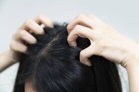 شوره سر چیست و چگونه به وجود می آید ؟