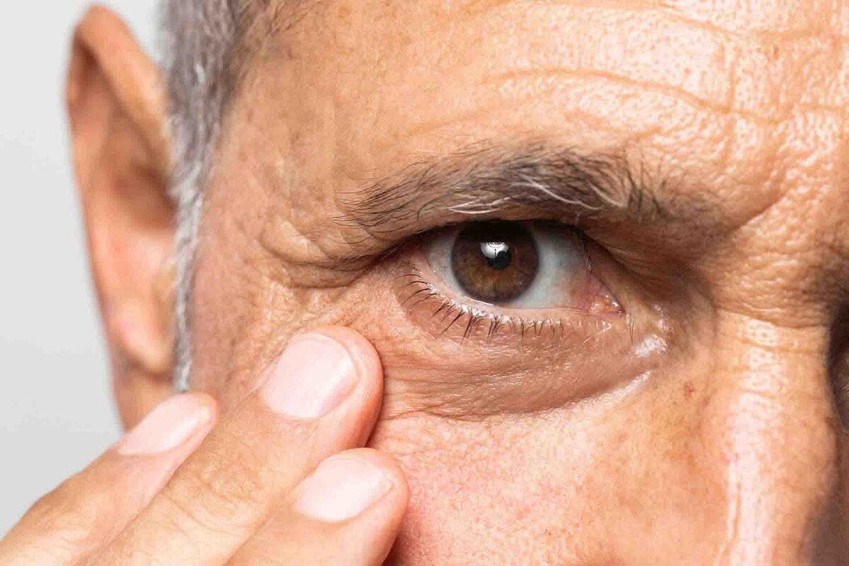 پیرچشمی چیست و چگونه درمان می‌شود؟ | علائم، علل و راهکارهای مؤثر