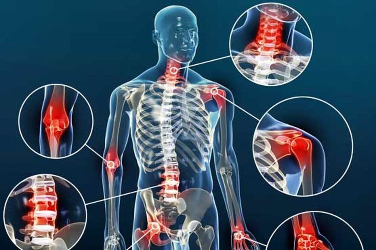 آرتروز چیست؟ | علائم، علل، درمان و روش‌های پیشگیری