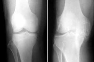 کاهش فاصله مفصلی؛ نخستین نشانه ساییدگی زانو