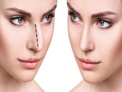 چند نوع عمل زیبایی بینی داریم؟